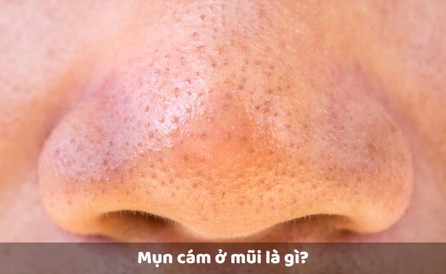Mụn cám ở mũi là gì?