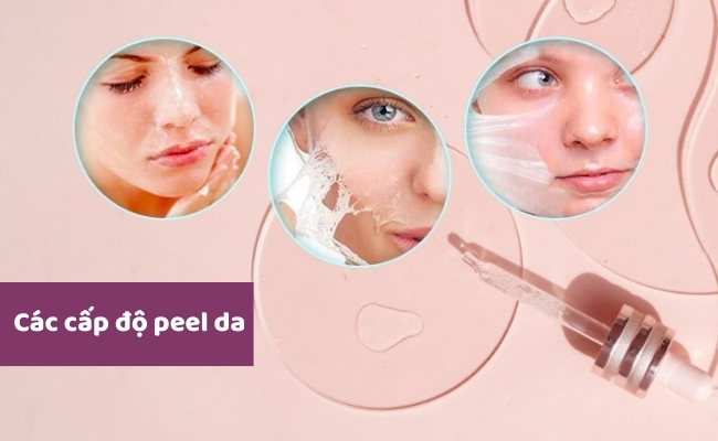 Các cấp độ peel da