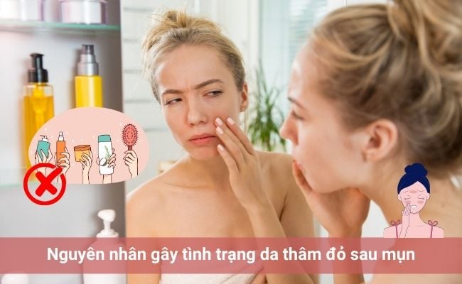 Nguyên nhân gây tình trạng da thâm đỏ sau mụn