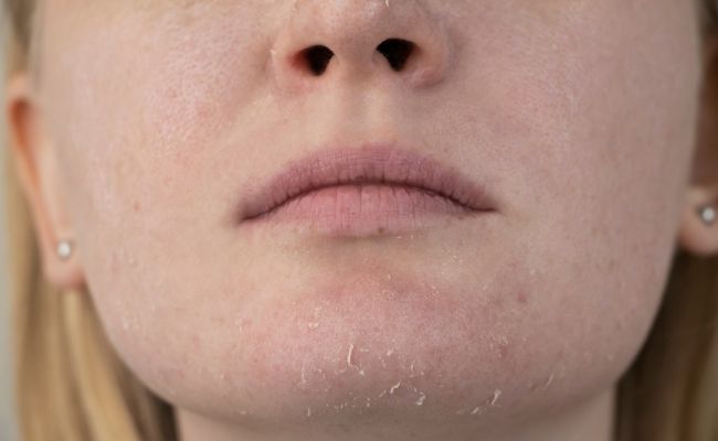 các cấp độ của làn da khô