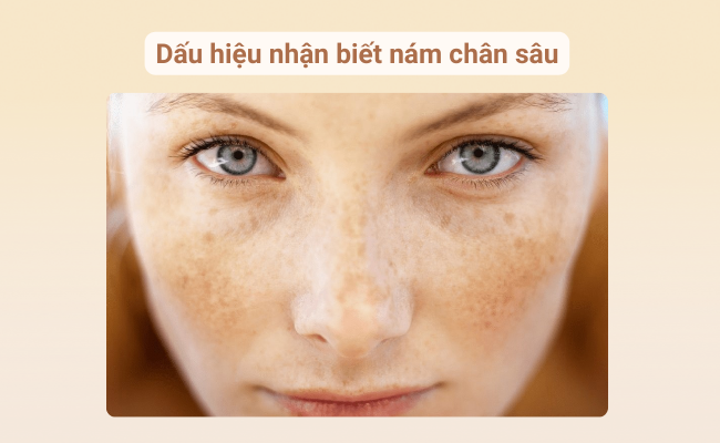 Cận cảnh làn da xuất hiện mảng sẫm màu đậm, đối xứng hai bên gò má – dấu hiệu điển hình của nám chân sâu.