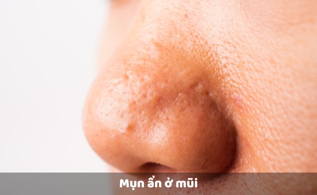 Mụn ẩn ở mũi

