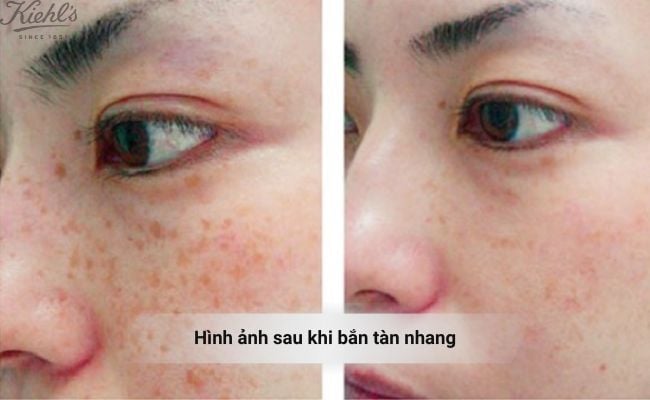 Hình ánh sau khi bắn tàn nhang