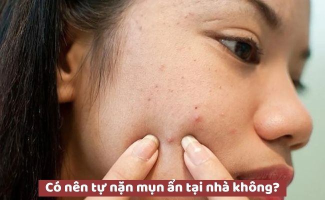 Có nên tự nặn mụn ẩn tại nhà không?
