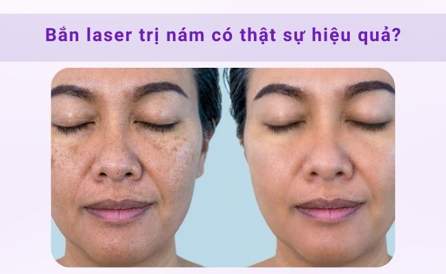 Da cải thiện rõ rệt sau khi sử dụng laser trị nám