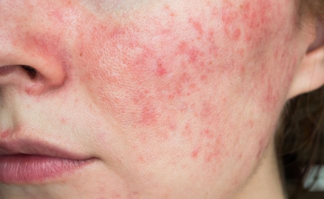 Da nổi mẩn đỏ là bị gì?