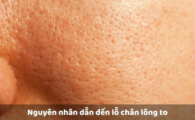 Nguyên nhân dẫn đến lỗ chân lông to

