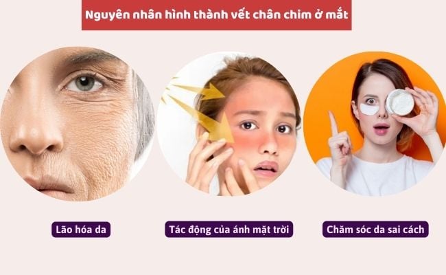 Nguyên nhân hình thành vết chân chim ở mắt