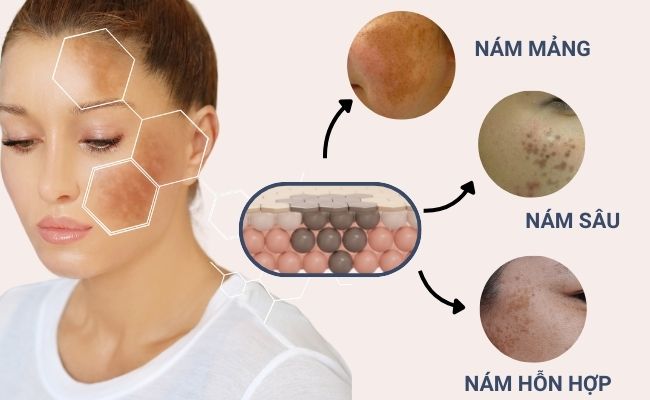 Các loại nám da thường gặp