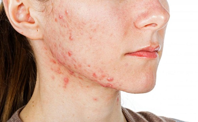 Mụn ở quai hàm - vị trí mụn nói lên điều gì?