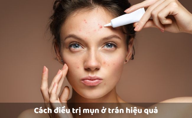 Cách điều trị mụn ở trán hiệu quả bằng Thuốc bôi ngoài da