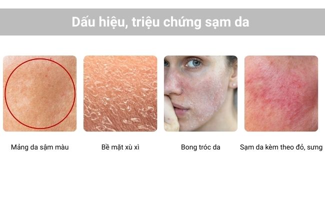 Triệu chứng nhận biết sạm da