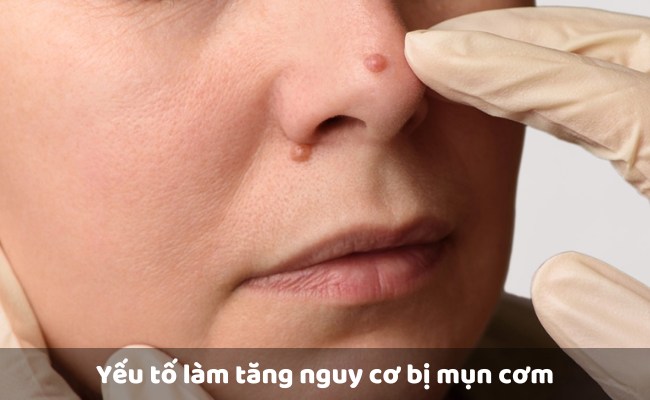 Yếu tố làm tăng nguy cơ bị mụn cơm

