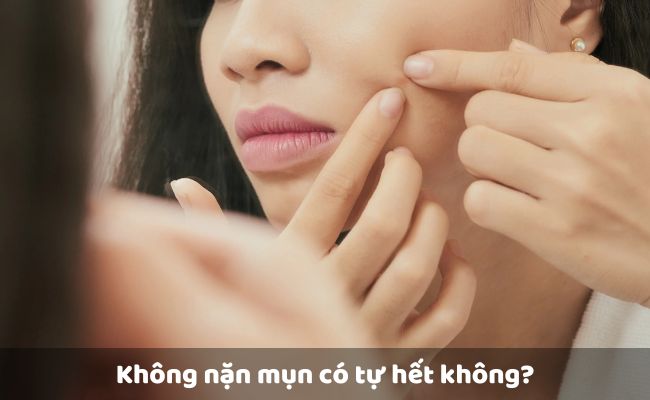 Không nặn mụn có tự hết không?