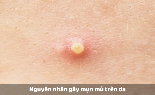 Nguyên nhân gây mụn mủ trên da