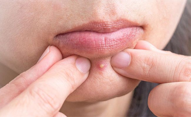 Mụn bọc ở cằm có nên nặn không?
