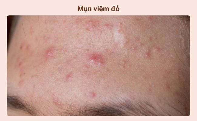 Các loại mụn viêm thường gặp và đặc điểm của chúng - Mụn viêm đỏ