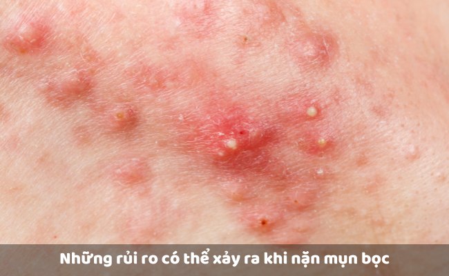 Những rủi ro có thể xảy ra khi nặn mụn bọc