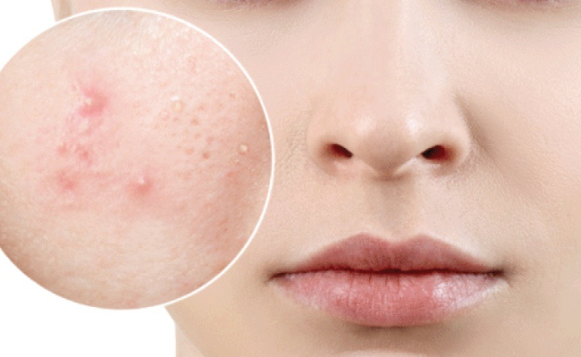 nguyên nhân dùng niacinamide bị lên mụn