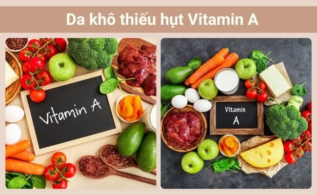 Da khô do thiếu vitamin A