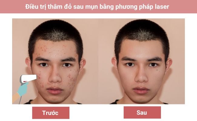 Cách trị thâm đỏ sau mụn nhanh và hiệu quả nhất