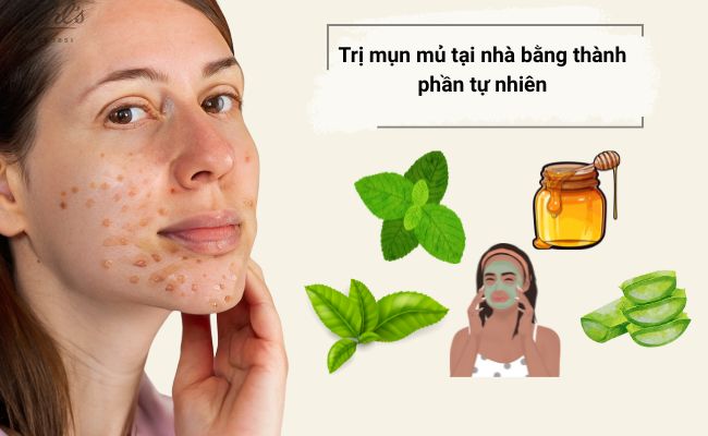 Cách trị mụn mủ với sản phẩm chứa thành phần tự nhiên