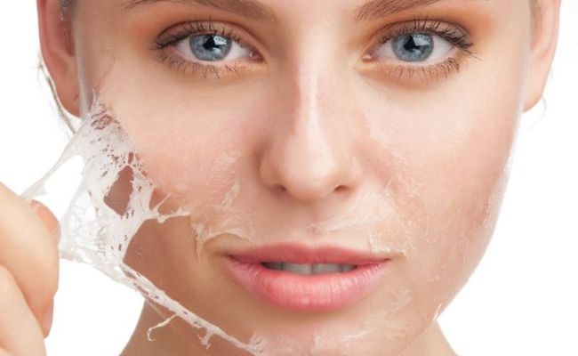 Trị tăng sắc tố da hiệu quả bằng phương pháp peel da hóa học