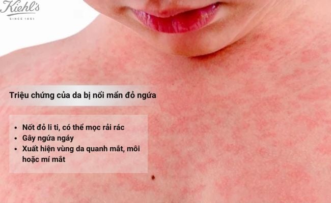 Triệu chứng của da bị nổi mẩn đỏ ngứa là gì?