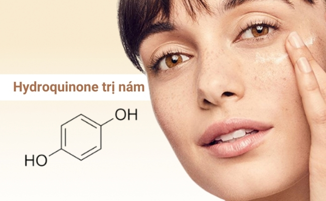 Cách trị nám bằng Hydroquinone an toàn, hiệu quả