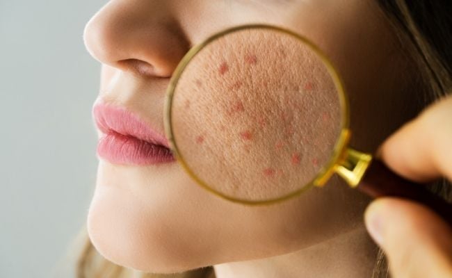 nguyên nhân gây da dầu mụn lỗ chân lông to