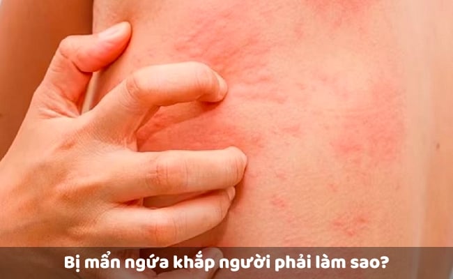 Cách trị da nổi mẩn đỏ ngứa trên mặt tại nhà bằng phương pháp tự nhiên