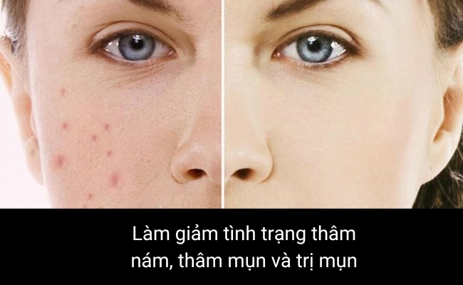 Serum Vitamin C có tác dụng làm giảm tình trạng thâm nám thâm mụn và trị mụn