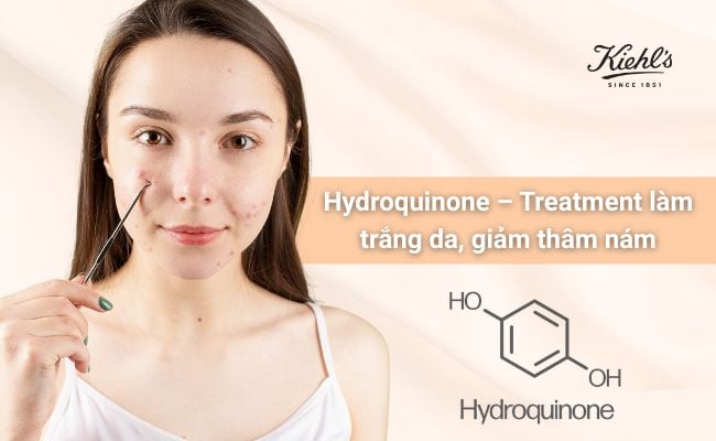 Các loại treatment trị mụn phổ biến, an toàn, hiệu quả

