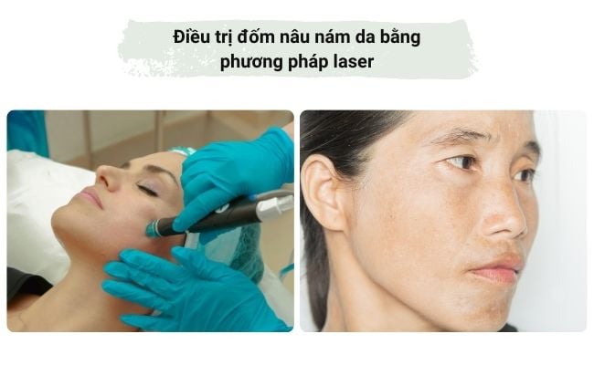 Điều trị đốm nâu nám da bằng phương pháp laser