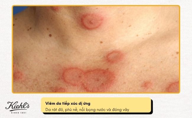 Viêm da tiếp xúc dị ứng