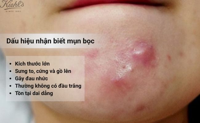 Dấu hiệu nhận biết các loại mụn bọc
