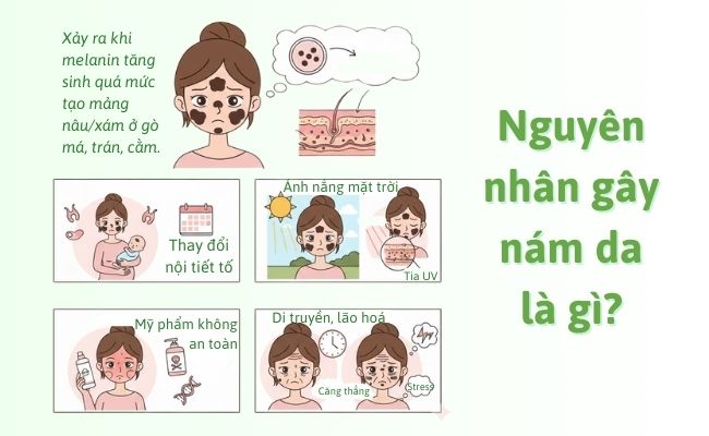 Nguyên nhân gây nám da là gì?