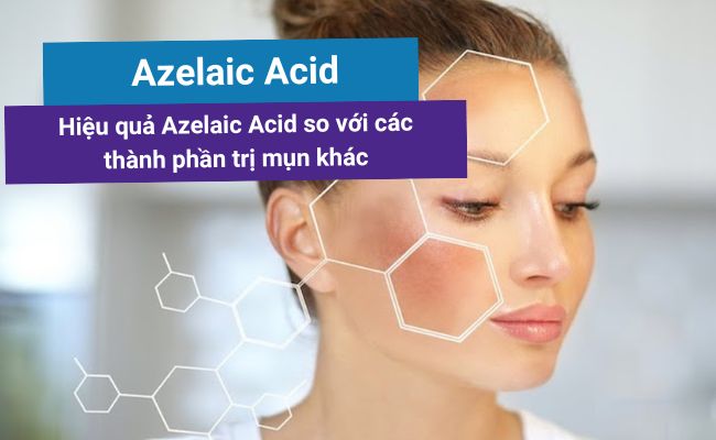 Hiệu quả của Azelaic Acid so với các thành phần trị mụn khác