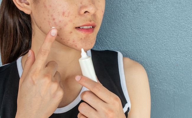 Thuốc chấm mụn là gì?