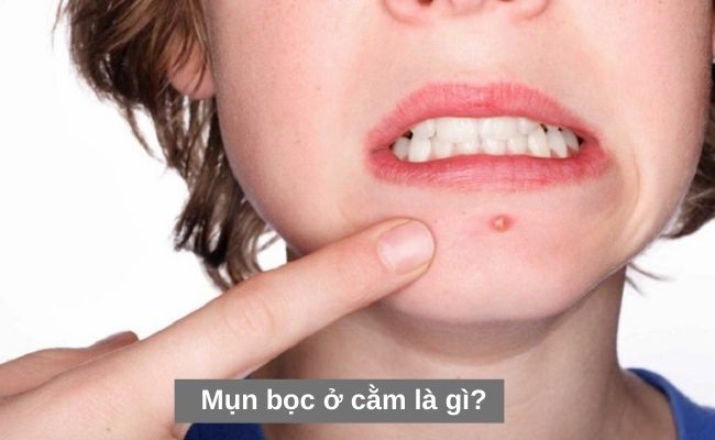 Mụn bọc ở cằm là gì?