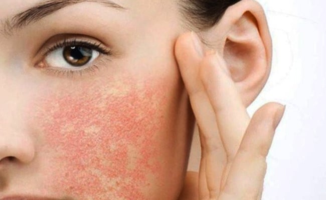 azelaic aicd không nên kết hợp với gì không gây tác dụng phụ