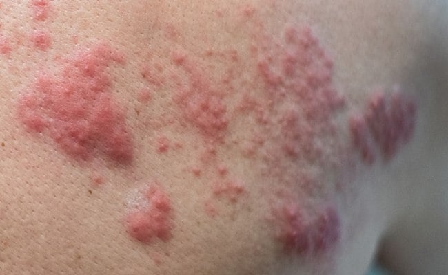 Nổi mụn đỏ trên da do dị ứng

