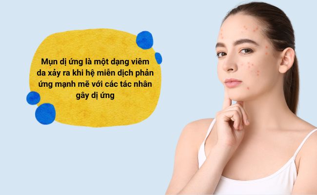 Mụn dị ứng thường biểu hiện qua các triệu chứng như ngứa, sưng và xuất hiện các nốt mụn nhỏ