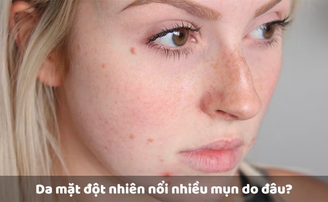 Nguyên nhân khiến da mặt đột nhiên nổi nhiều mụn