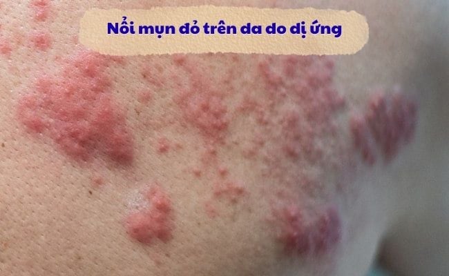 Nổi mụn đỏ trên da do dị ứng