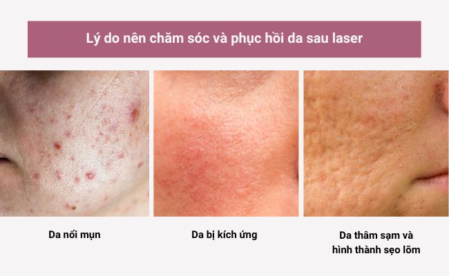 Lý do nên chăm sóc và phục hồi da sau laser