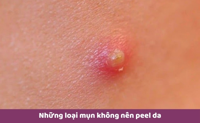 Những loại mụn không nên peel da