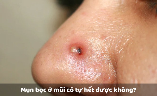Mụn bọc ở mũi có tự hết được không?