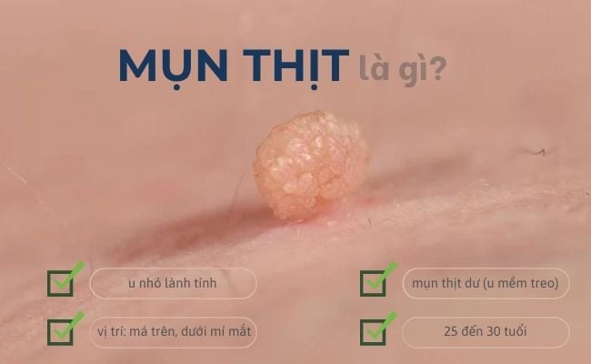 Mụn thịt là gì?