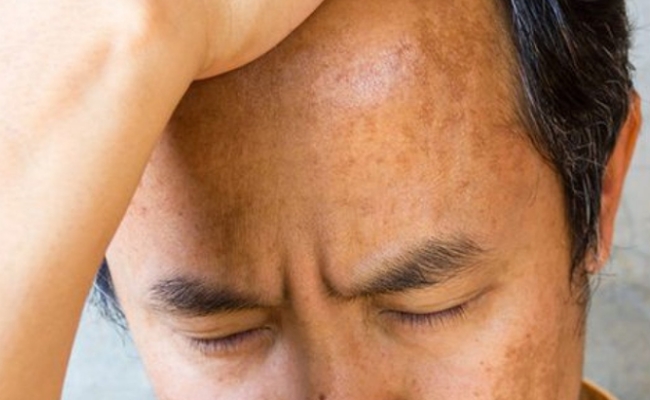 Nam giới ít bị nám hơn nữ, nhưng tiếp xúc nhiều với ánh nắng vẫn có nguy cơ cao